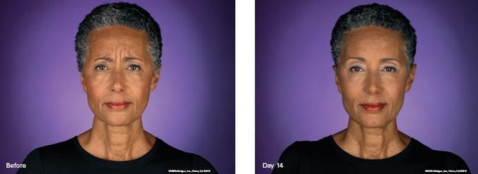 BOTOX before & after