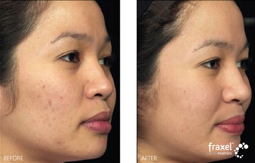 acne solutions corpus christi