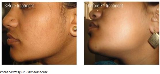 LEDI EPI laser hair removal