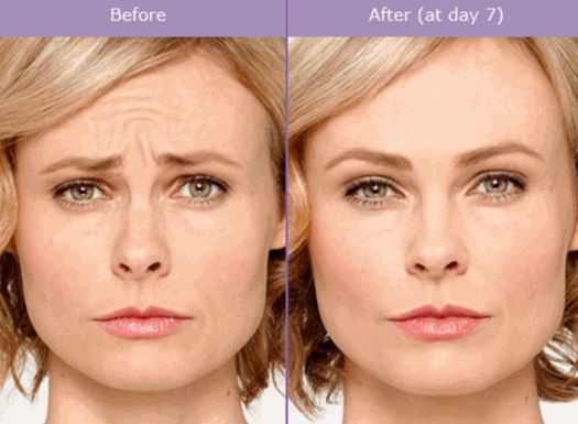 botox before and after