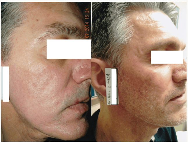 Intensif before and after